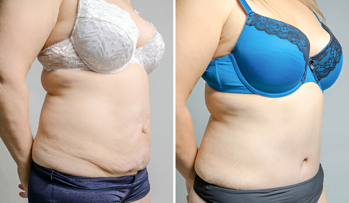 tummy-tuck-b4-aftr-02